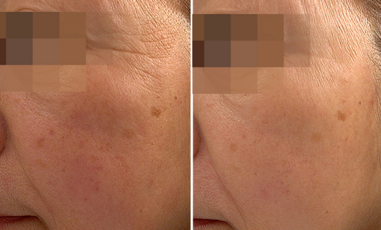 Before/After using glow up duo